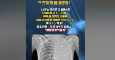 Cô bé Chiết Giang bị phổi trắng sau 1 ngày sốt! Cư dân mạng: Đều là sau khi tiêm vắc-xin mới trở nên như vậy